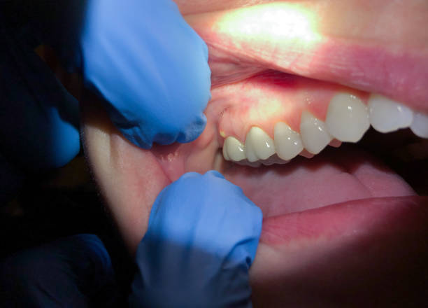 Best Emergency Tooth Extraction in Sewaren, NJ